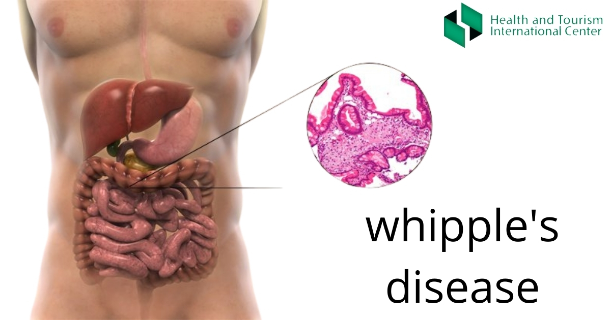 Whipple_s disease